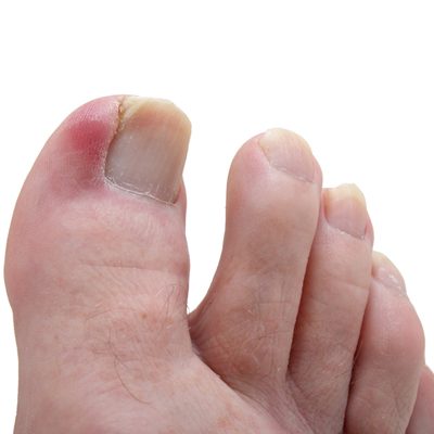 a healthy toenail has been damaged, and has become ingrown, infecting the toe and causing it to become septic